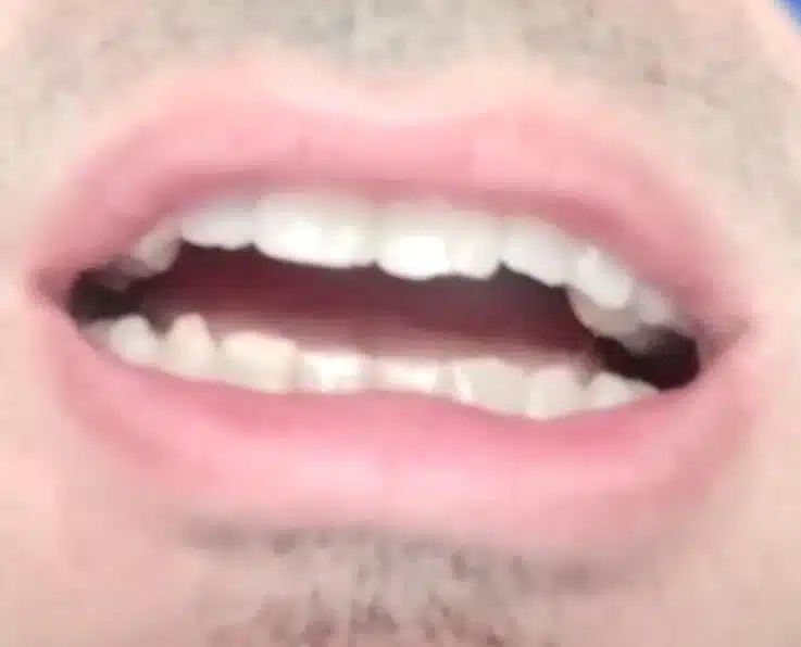 abertura mínima de la mordida