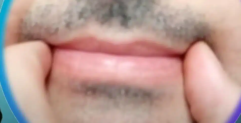 comisuras fijas en viento metal